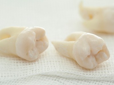 智齒疼了，這牙非拔不可嗎？